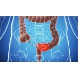 Pachet 3x Graviola Annona Muricata Antitumoral Anticancer 180 capsule Livrare Gratuita Prospect