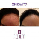 NEORETIN Pigment Peel Pads 6x1ml