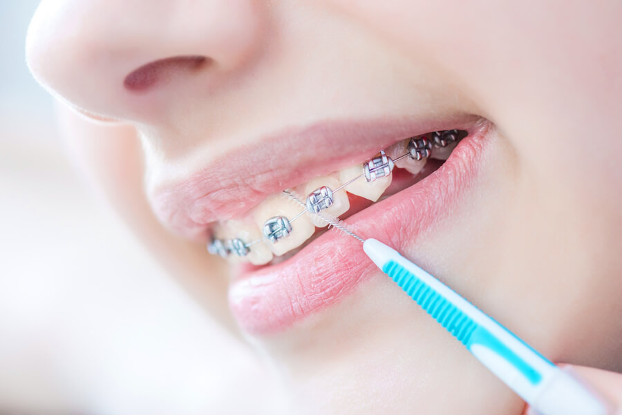 Rutina de îngrijire a aparatului dentar