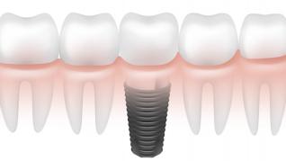 Coroanele dentare