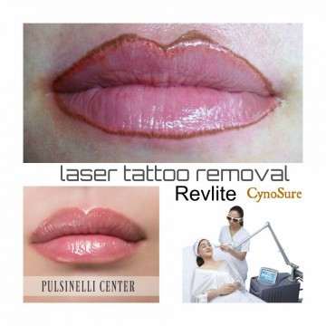 DISAGIO PER LE LABBRA MAL-TATUATE?