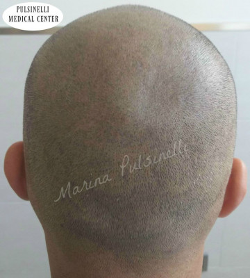 TRICOPIGMENTAZIONE PER ALOPECIA UNIVERSALE (SEDUTA DI 5 ORE)
