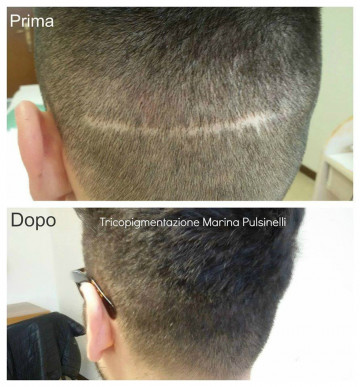 COPERTURA CICATRICI CON TRICOPIGMENTAZIONE (SEDUTA DURATA UN’ ORA)