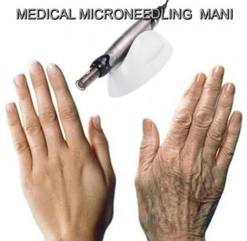 RINGIOVANIMENTO DELLE MANI CON MEDICAL MICRONEEDLING