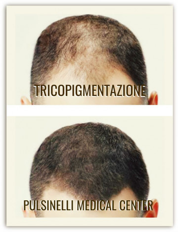 TRICOPIGMENTAZIONE PER RIDURRE LE TRASPARENZE DA DIRADAMENTO CAPELLI (SEDUTA DI 4 ORE)