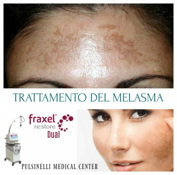 TRATTAMENTO DEL MELASMA CON LASER FRAXEL VISO PARZIALE