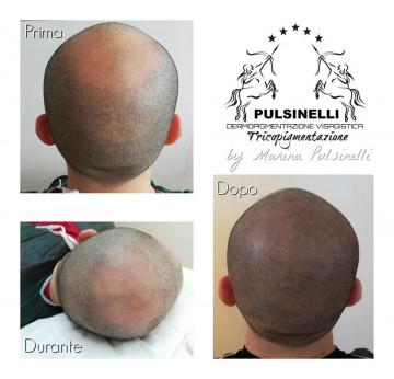 INFOLTIMENTO DEI CAPELLI CON TRICOPIGMENTAZIONE (SEDUTA DI 2 ORE)