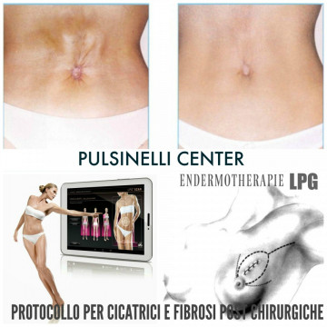 ENDERMOTHERAPIE LPG: PROTOCOLLO CICATRICI FIBROSI E INFIAMMAZIONI