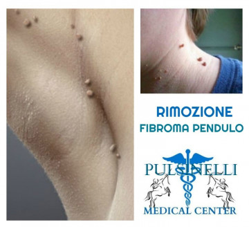 RIMOZIONE DEL FIBROMA PENDULO