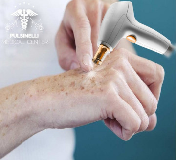 IL LASER CHE TOGLIE LE MACCHIE DALLE MANI