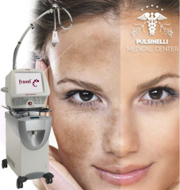 TRATTAMENTO DEL MELASMA CON LASER FRAXEL VISO COMPLETO