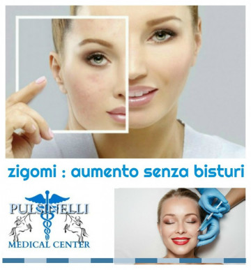 Aumento degli Zigomi