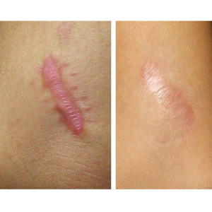 Plasturi cicatrici Resolve Skin SPF50+, 25 x 4 cm, 1 bucată