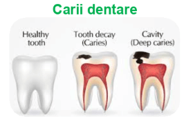 Carii dentare