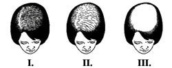 Evolutia alopeciei la femei
