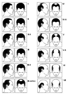 Evolutia alopeciei la barbati
