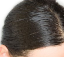 Matreata si dermatita seboreica