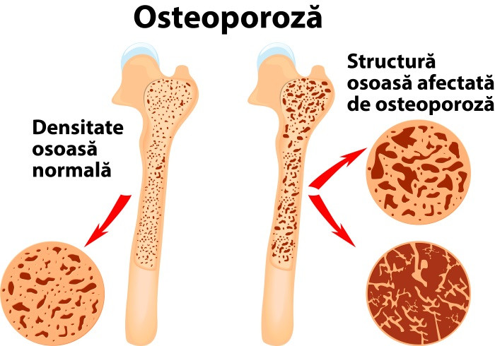 Solutii osteoporoza Enlife