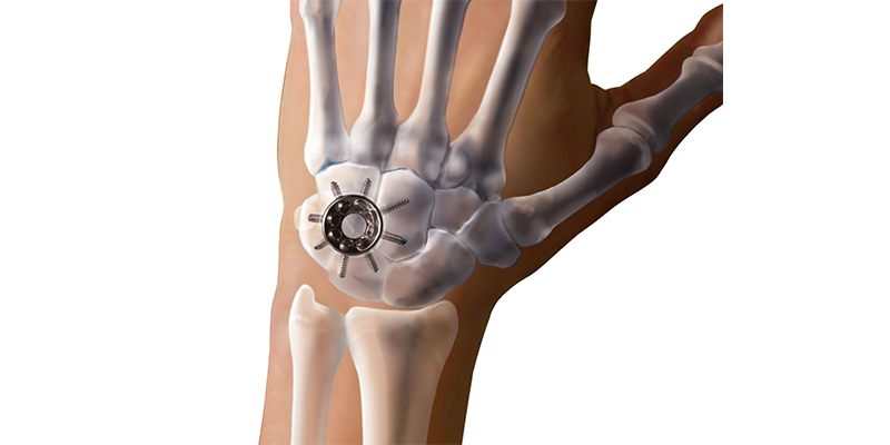 osteoartroza articulației gleznei tratament de 2 3 grade