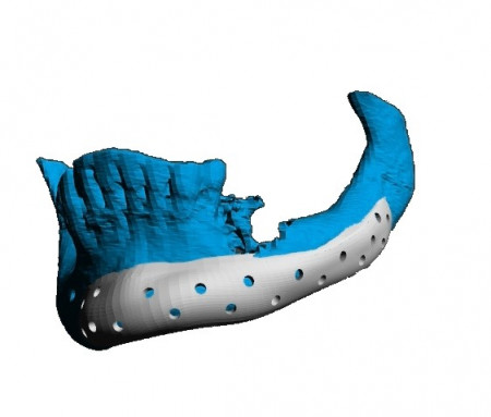 Placa (Cranioplastie), defecte BMF