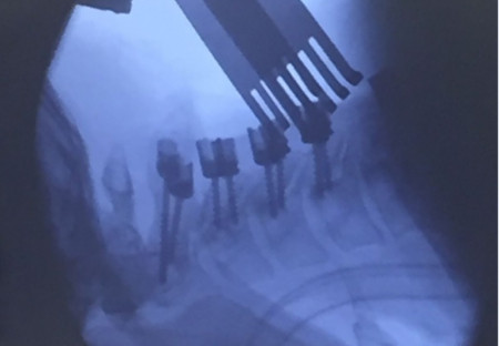Sistem fixare posterior din Titan (suruburi poliaxiale, posterioare cervicale , AP Trauma si Oncologie / Tumori)