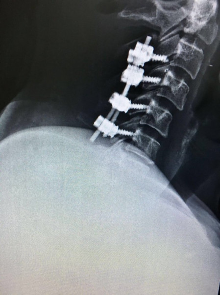 Sistem fixare posterior din Titan (suruburi poliaxiale, posterioare cervicale , AP Trauma si Oncologie / Tumori)
