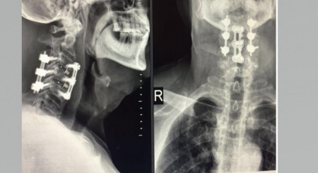 Sistem fixare posterior din Titan (suruburi poliaxiale, posterioare cervicale , AP Trauma si Oncologie / Tumori)