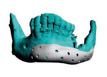 Implant mandibula Titan PSI Enlife Solutions