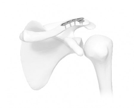 Placa acromioclaviculara poliaxiala pentru osteointeza fracturii de clavicula