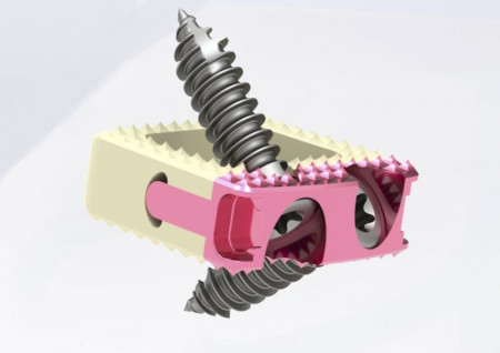 TITANOPEEK - Cage Vertebral Cervical cu suruburi de prindere si profil anatomic