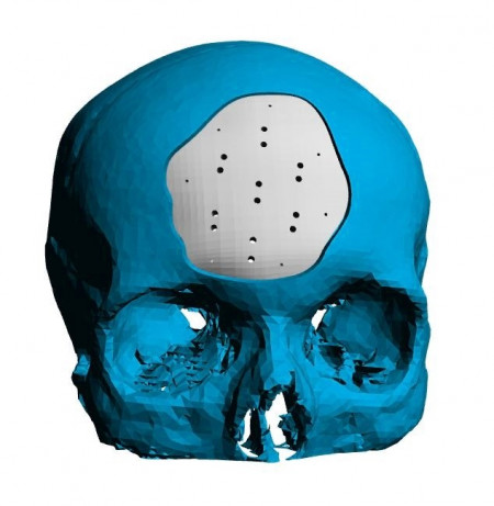Placa (Cranioplastie), defecte craniene