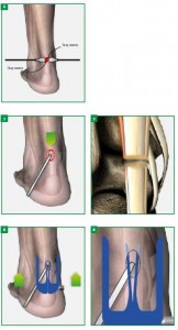 Achillon, solutie minim-invaziva pentru rupturile de tendon Ahile