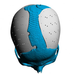 Placa (Cranioplastie), defecte craniene