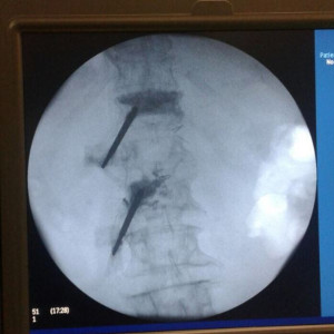 Vesta, Surub din Titan, fenestrat (Osteoporoza,  AP Trauma si Oncologie)