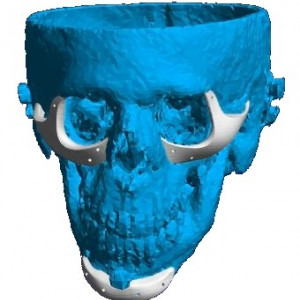 Placa (Cranioplastie), defecte BMF