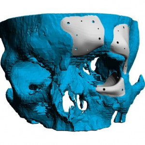 Placa (Cranioplastie), defecte ORL