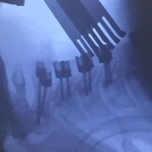 Sistem fixare posterior din Titan (suruburi poliaxiale, posterioare cervicale , AP Trauma si Oncologie / Tumori)