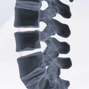TALOS, Cage vertebral TLIF posterior lombar din PEEK