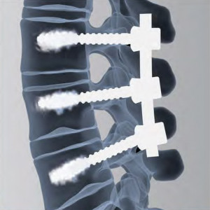 VESTA CEMENT INJECTABLE SCREW SPINAL FIXATION SYSTEM