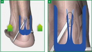 Achillon, solutie minim-invaziva pentru rupturile de tendon Ahile