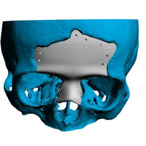 Placa (Cranioplastie), defecte ORL