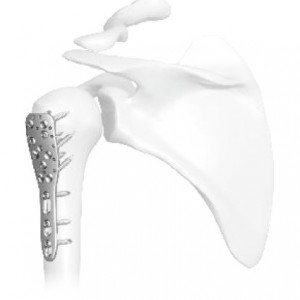 Placa de Humerus Proximal