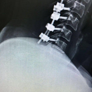 Sistem fixare posterior din Titan (suruburi poliaxiale, posterioare cervicale , AP Trauma si Oncologie / Tumori)
