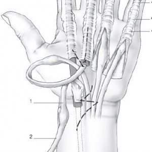 U.T.S - Universal Tendon Spacer