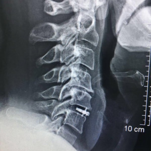 ARION, Cage Vertebral cervical expandabil