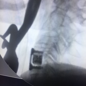 AURA, Suruburi fixare placa cervicala ( AP Trauma)
