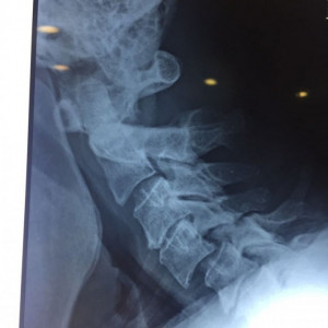 EOS Hybrid, Cage Vertebral cervical din PEEK