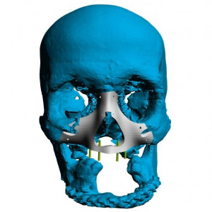 Placa (Cranioplastie), defecte BMF