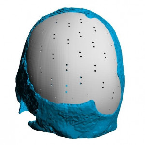 Placa (Cranioplastie), defecte craniene