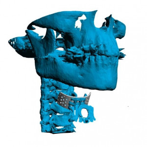 Placa (Cranioplastie), defecte ORL
